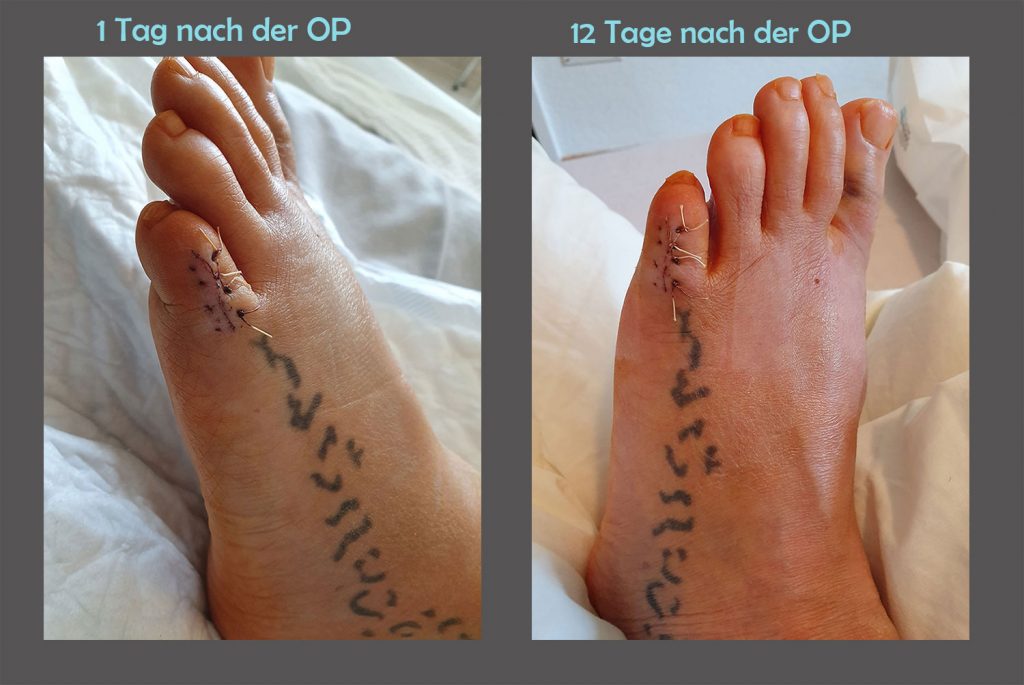 13 Tage nach meiner Hallux Valgus OP Ezris kleine Welt