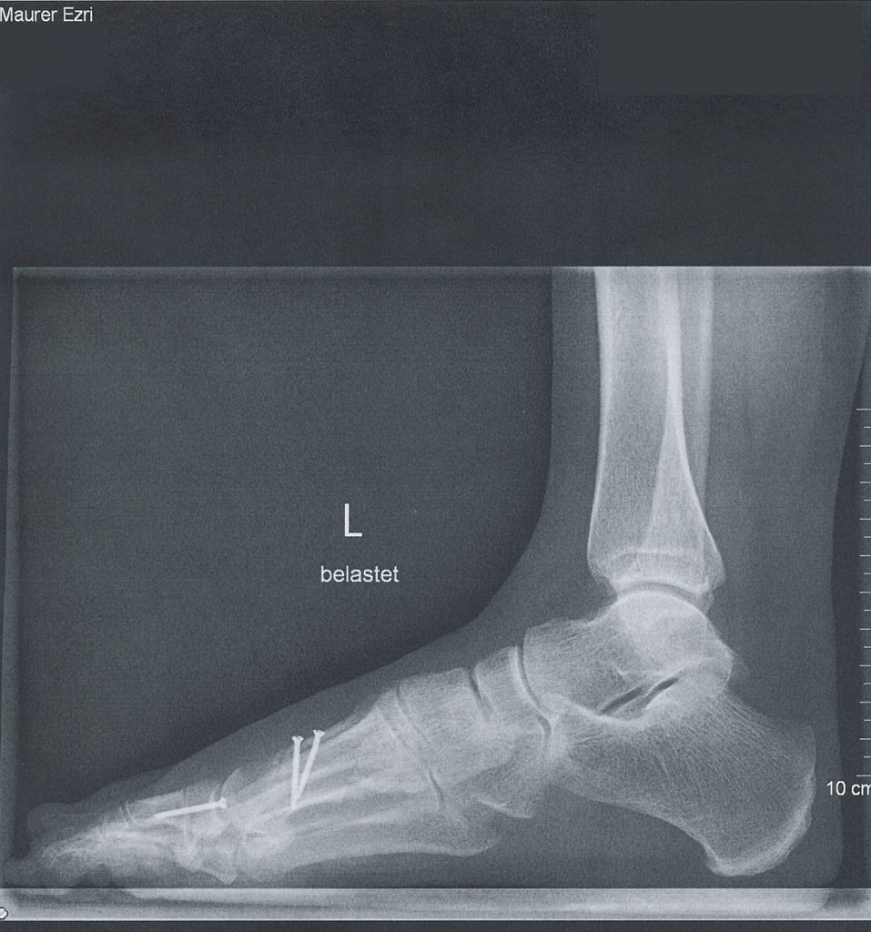Vier Wochen nach meiner Hallux Valgus OP | Ezris kleine Welt